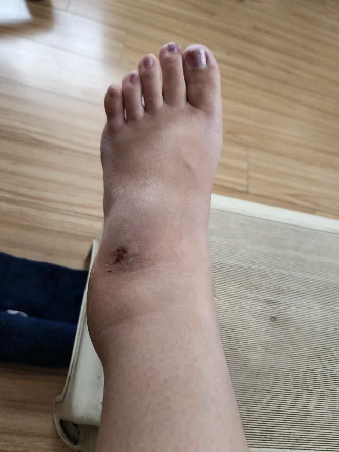 A swollen foot with a bruised ankle and a small abrasion, resting on a textured surface. The toes appear slightly discolored.