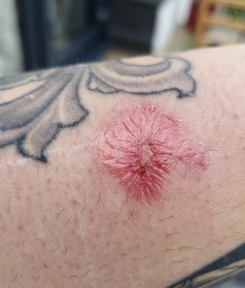 Close-up of a person's skin showing a raised, red, irritated area with a flower tattoo around it