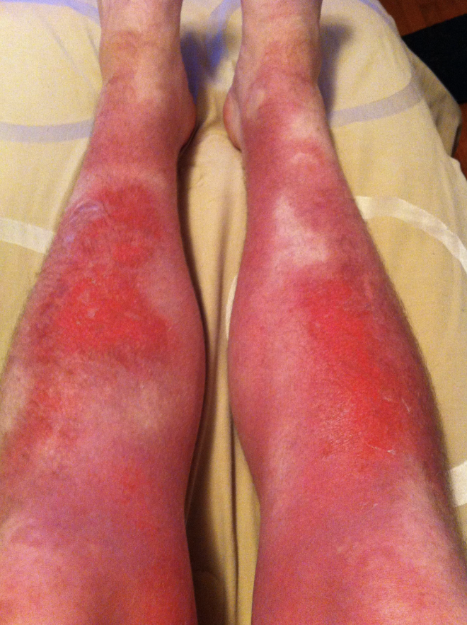 A person's lower legs showing significant irritation and redness, possibly due to sunburn or skin condition. No text or celebrities in the image