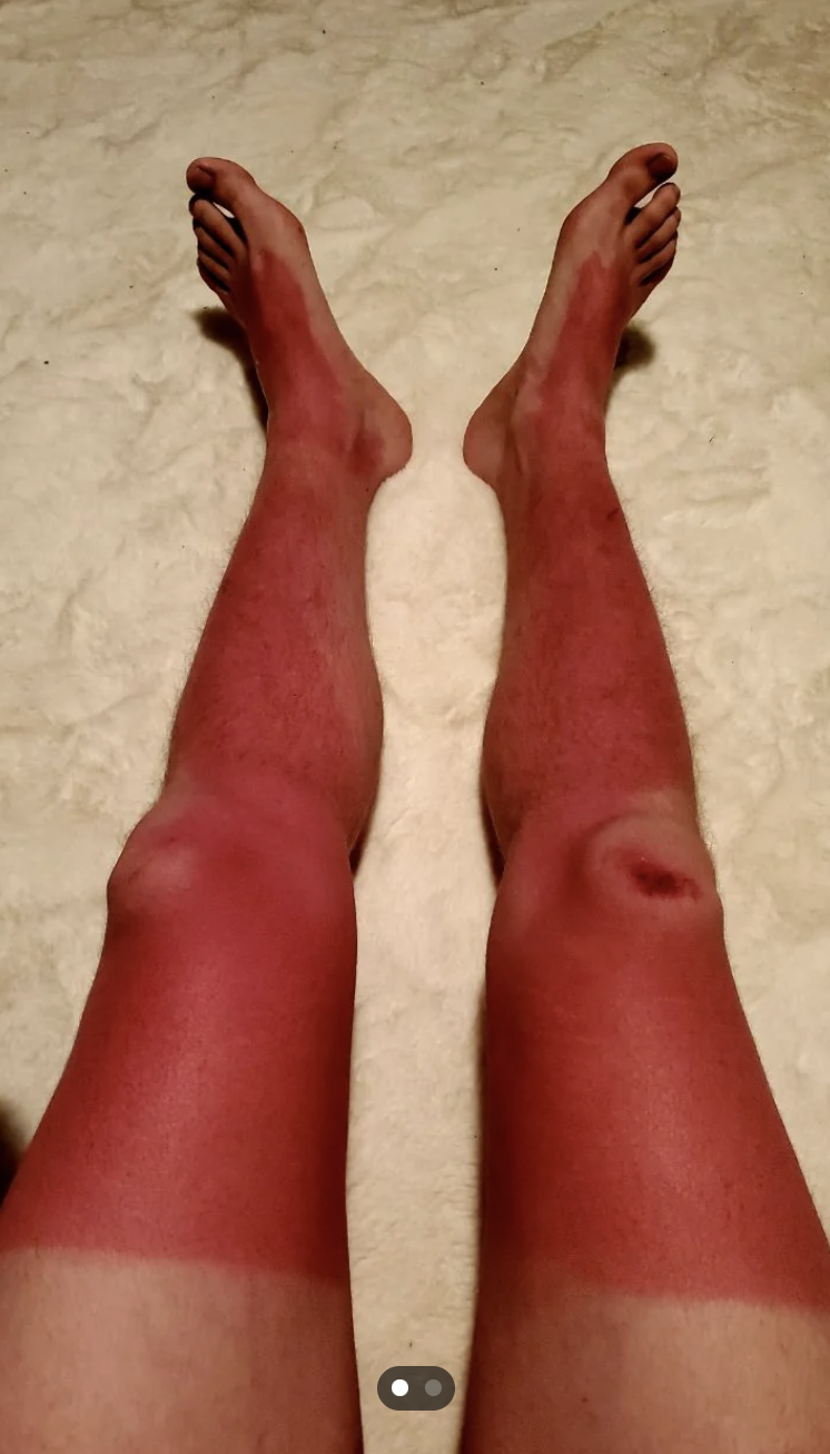 Two sunburned legs with distinct tan lines