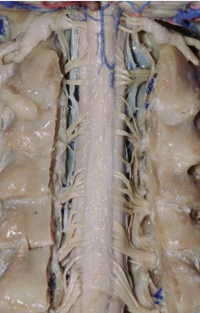 Close-up image showing a detailed view of a human spinal cord and nerves, exposing the vertebral bones, spinal canal, and nerve roots