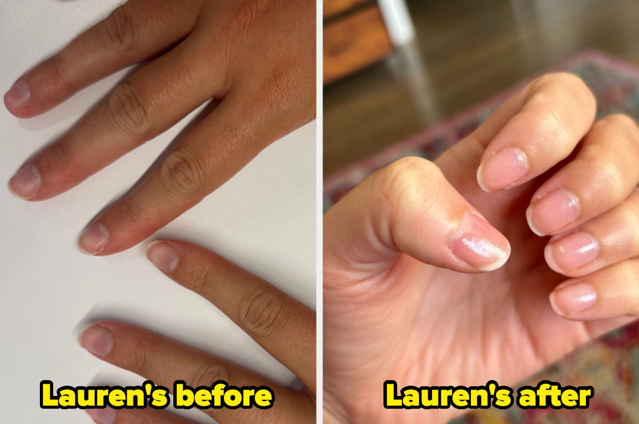 Side-by-side comparison of Lauren's nails before and after treatment, showing noticeable improvement in nail health
