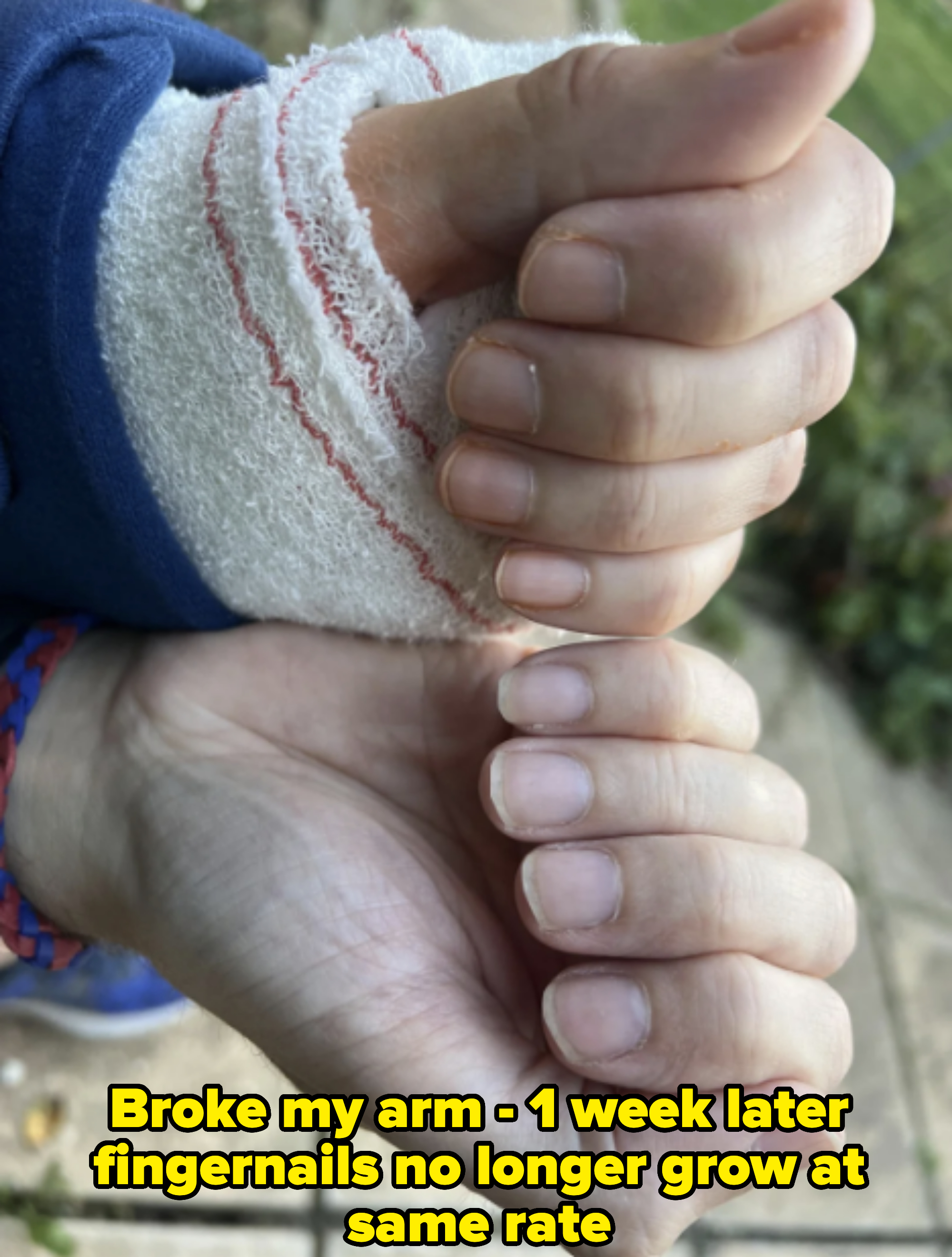Two hands are shown, one with a bandaged wrist giving a thumbs up, and the other hand is open with neatly trimmed nails. No identifiable persons are shown