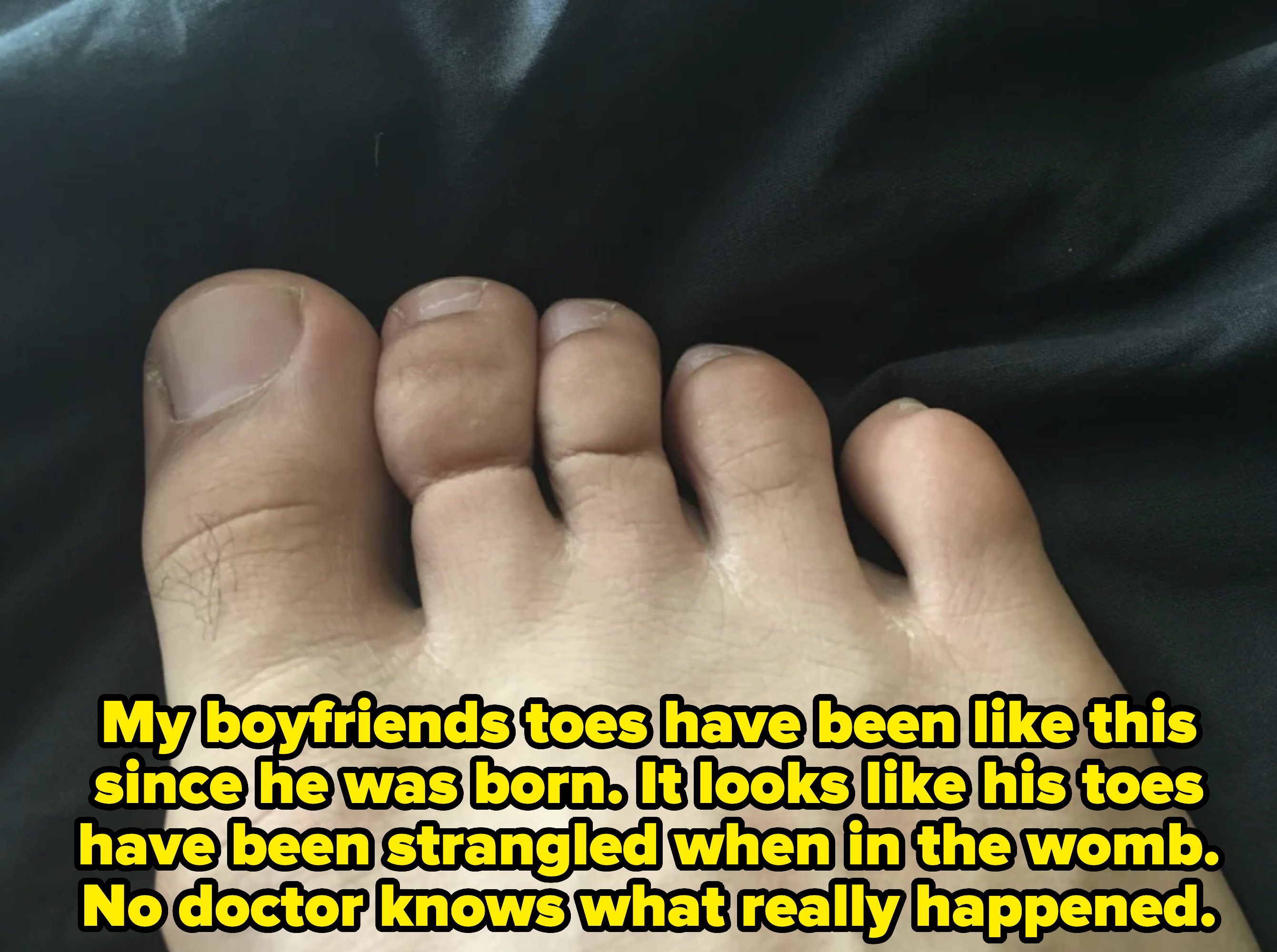 Close-up of a person's foot with visible toes and toenails