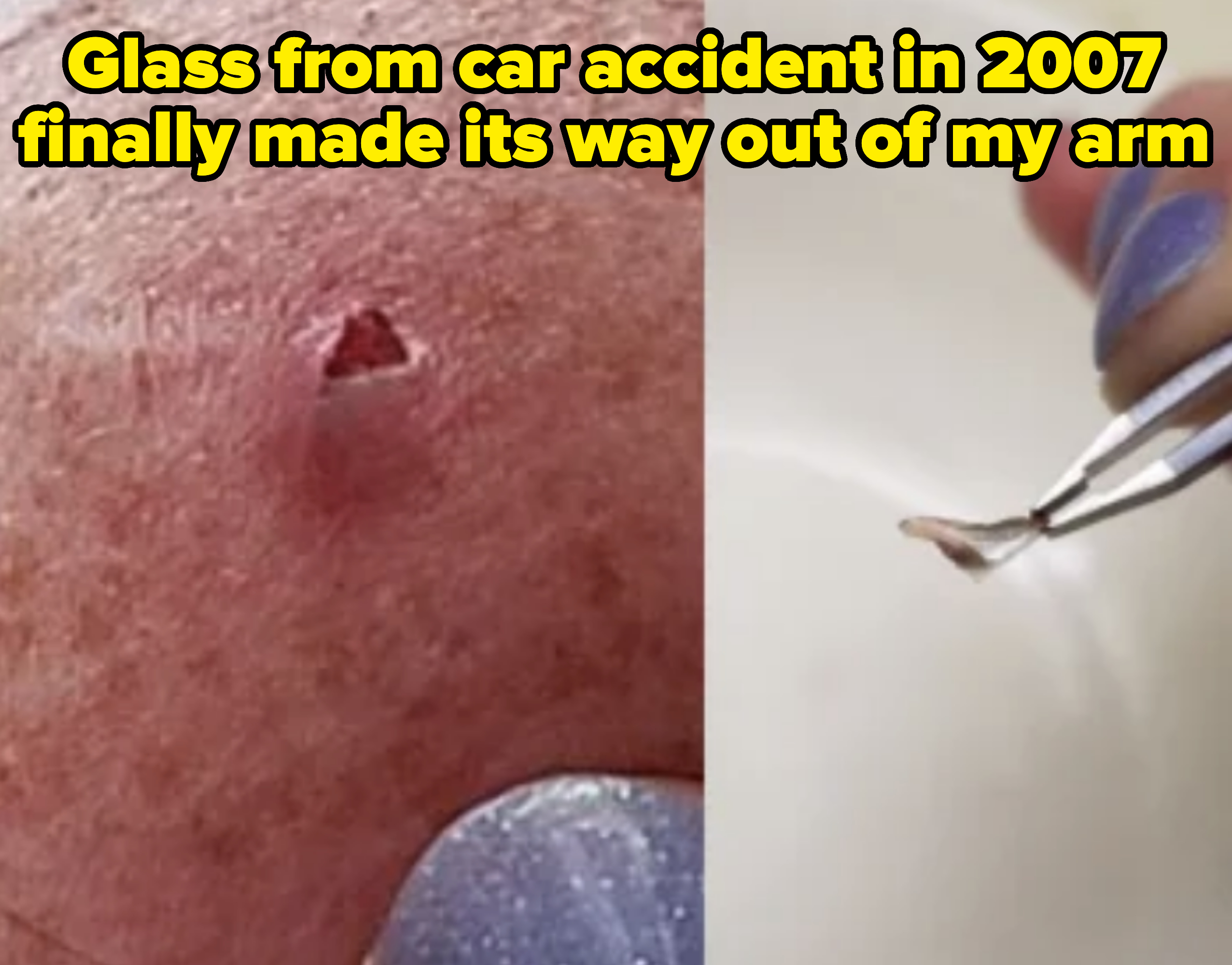 A tweezers holds a small object that was pulled from a red bump on skin