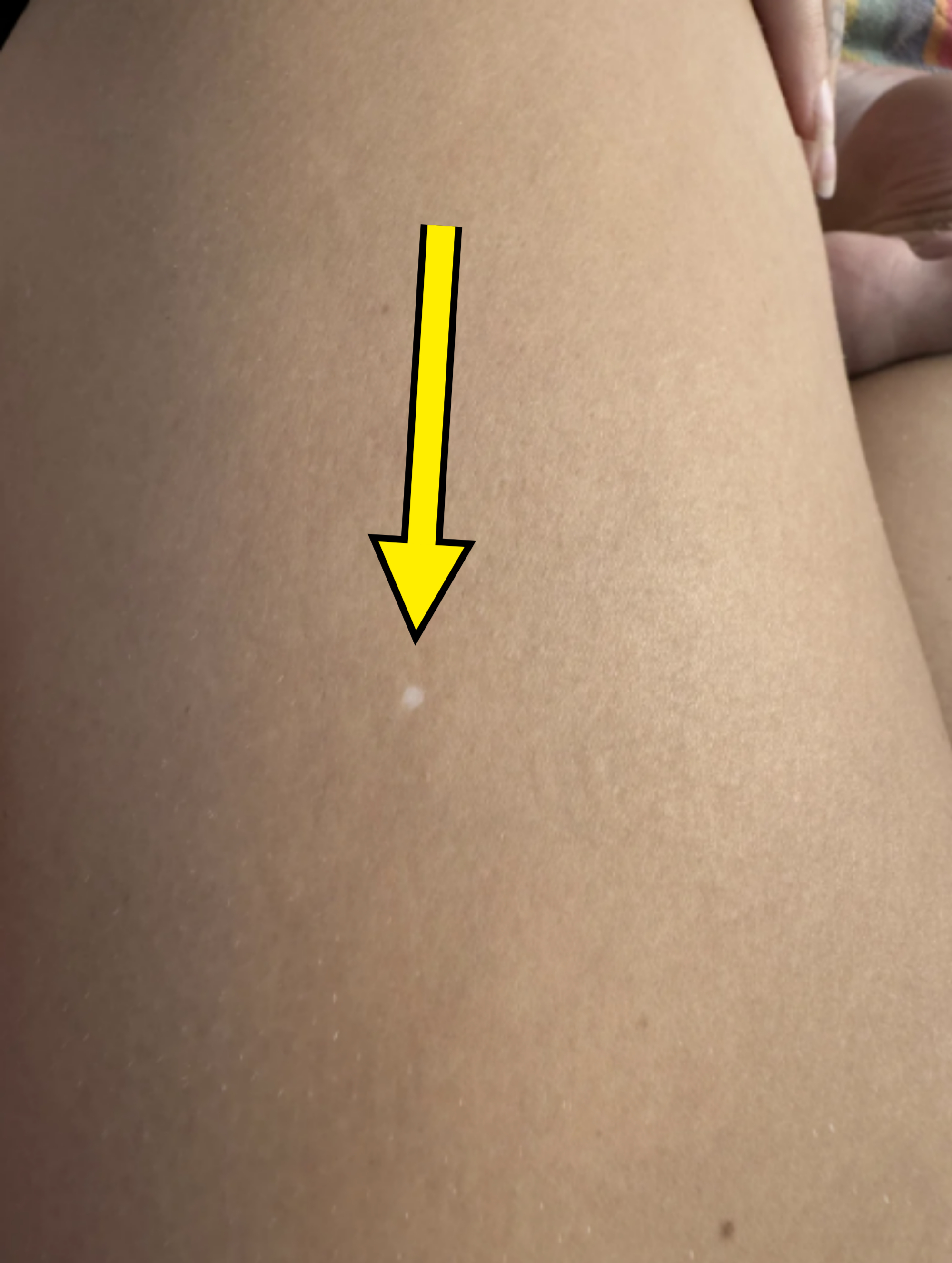Close-up of a person's leg showing a small white spot on the skin. The person's hand and toes are partially visible in the background
