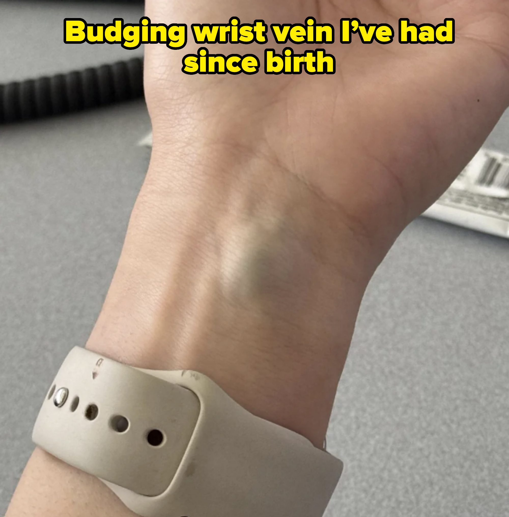 A close-up image of a person's wrist showing a visible bump under the skin. The person is wearing a watch with a light-colored band