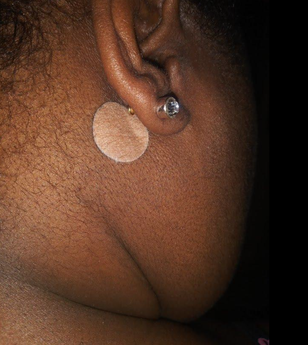 Close-up of a person's ear wearing a circular bandage and a stud earring