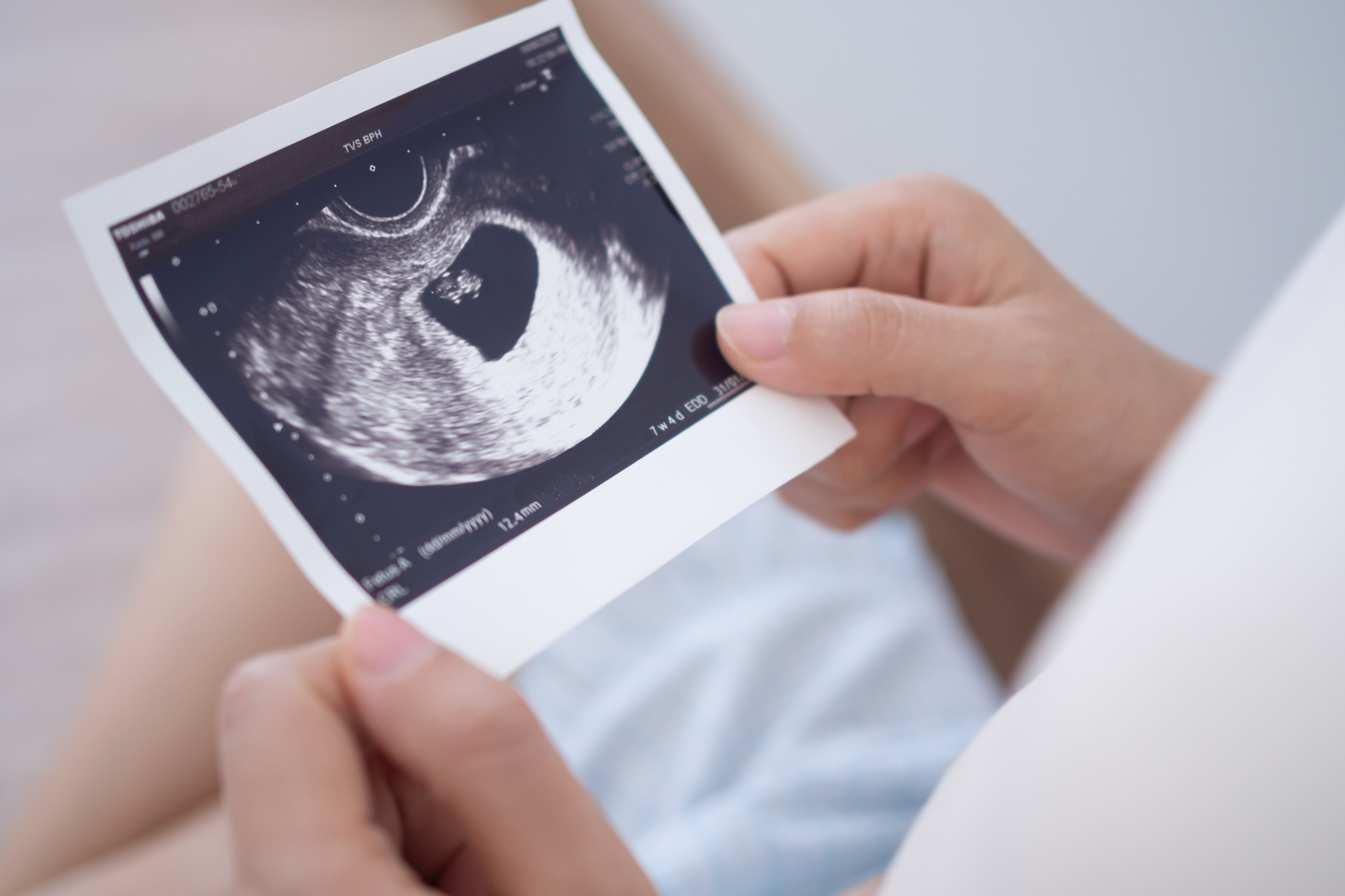 A close-up of a person's hands holding an ultrasound image displaying an early stage pregnancy