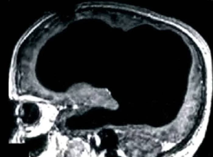 MRI scan of a human brain showing a large dark area likely representing a significant cavity or anomaly
