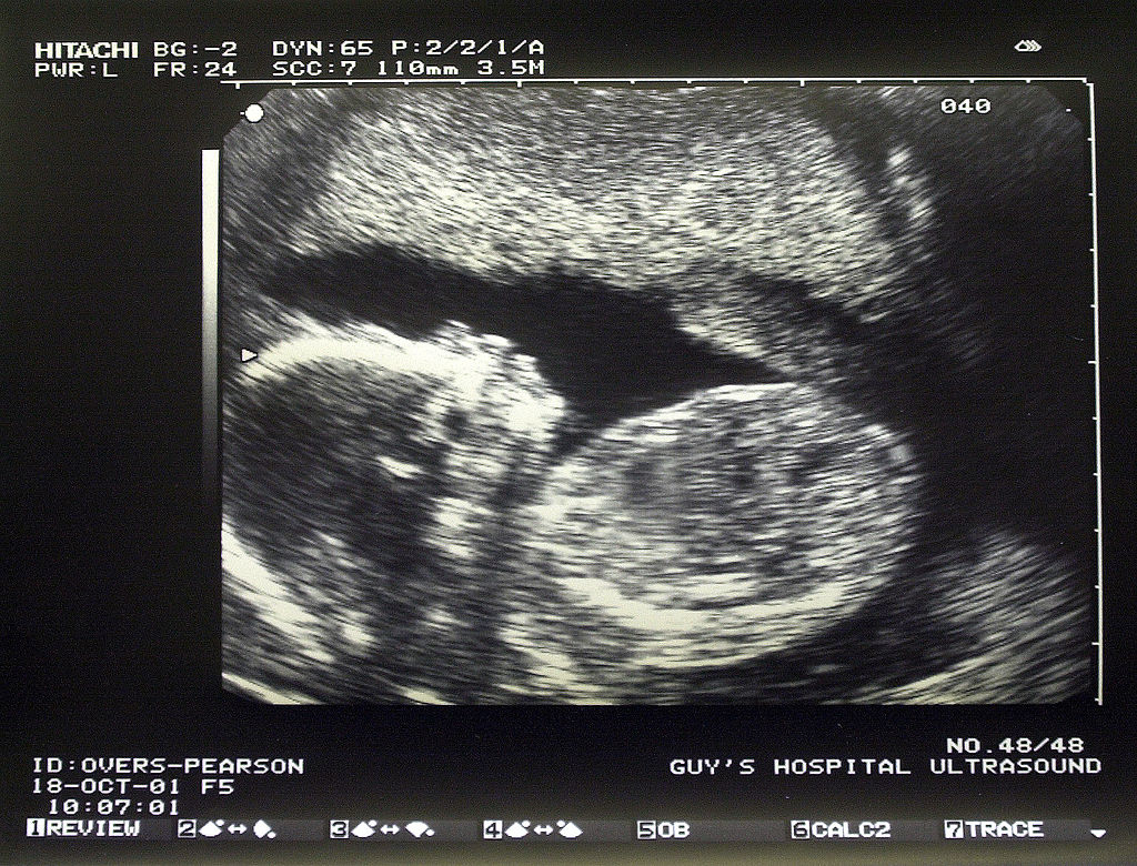 Ultrasound image displaying a developing fetus. It includes medical details such as the hospital name and date: October 18, 2001