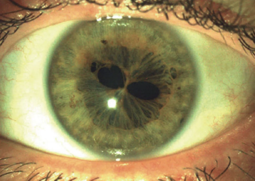 Close-up image of a human eye with a distinct anomaly showing irregularly shaped pupils