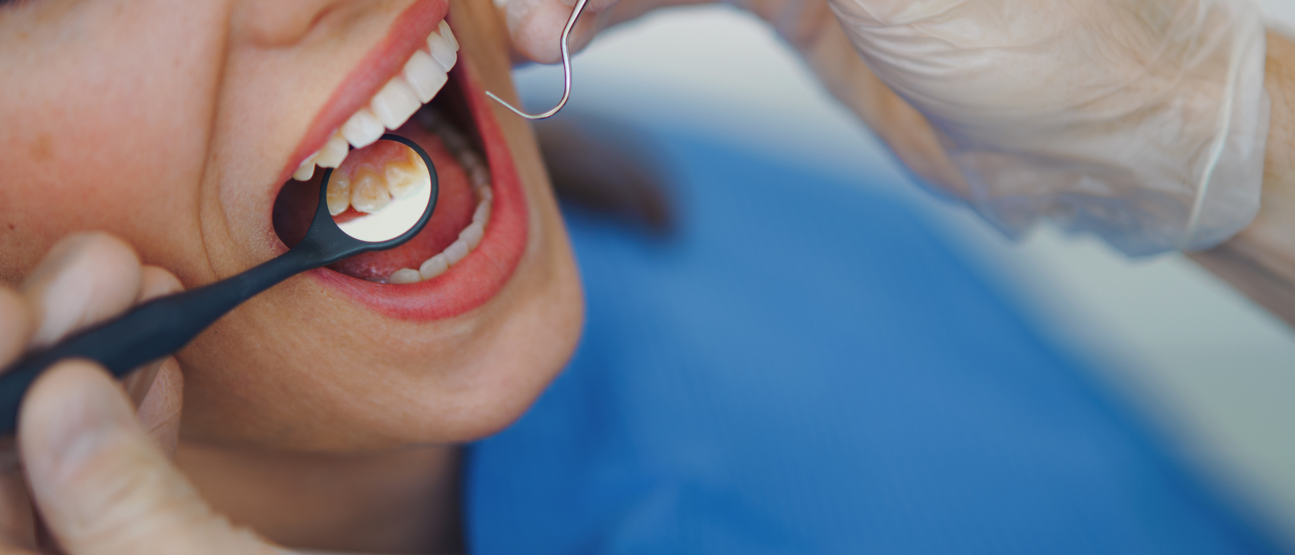 Close-up of a dental examination showing a person’s open mouth with a dentist&#x27;s mirror reflecting teeth