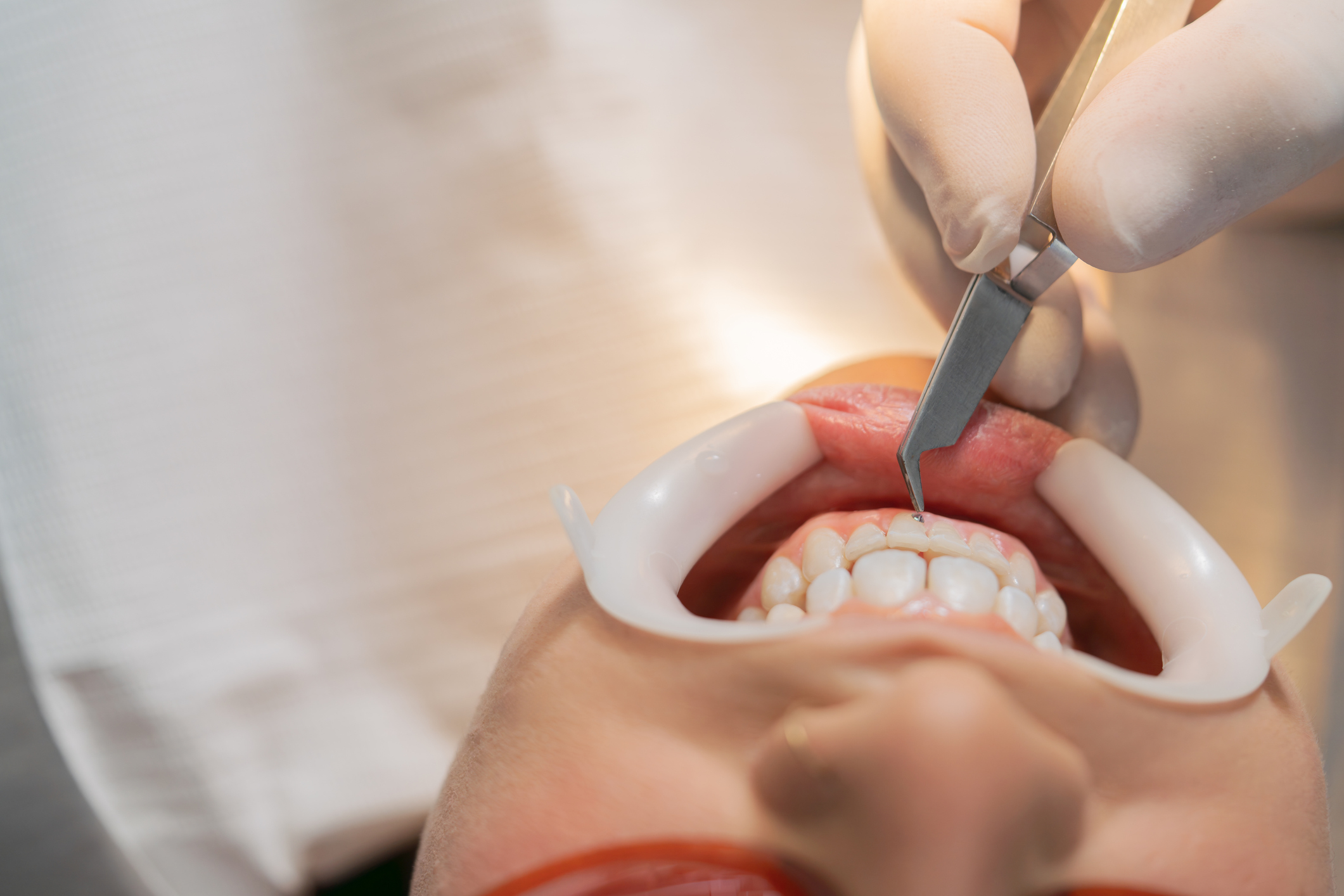 Person receiving a dental procedure with tools and a dental retractor in place