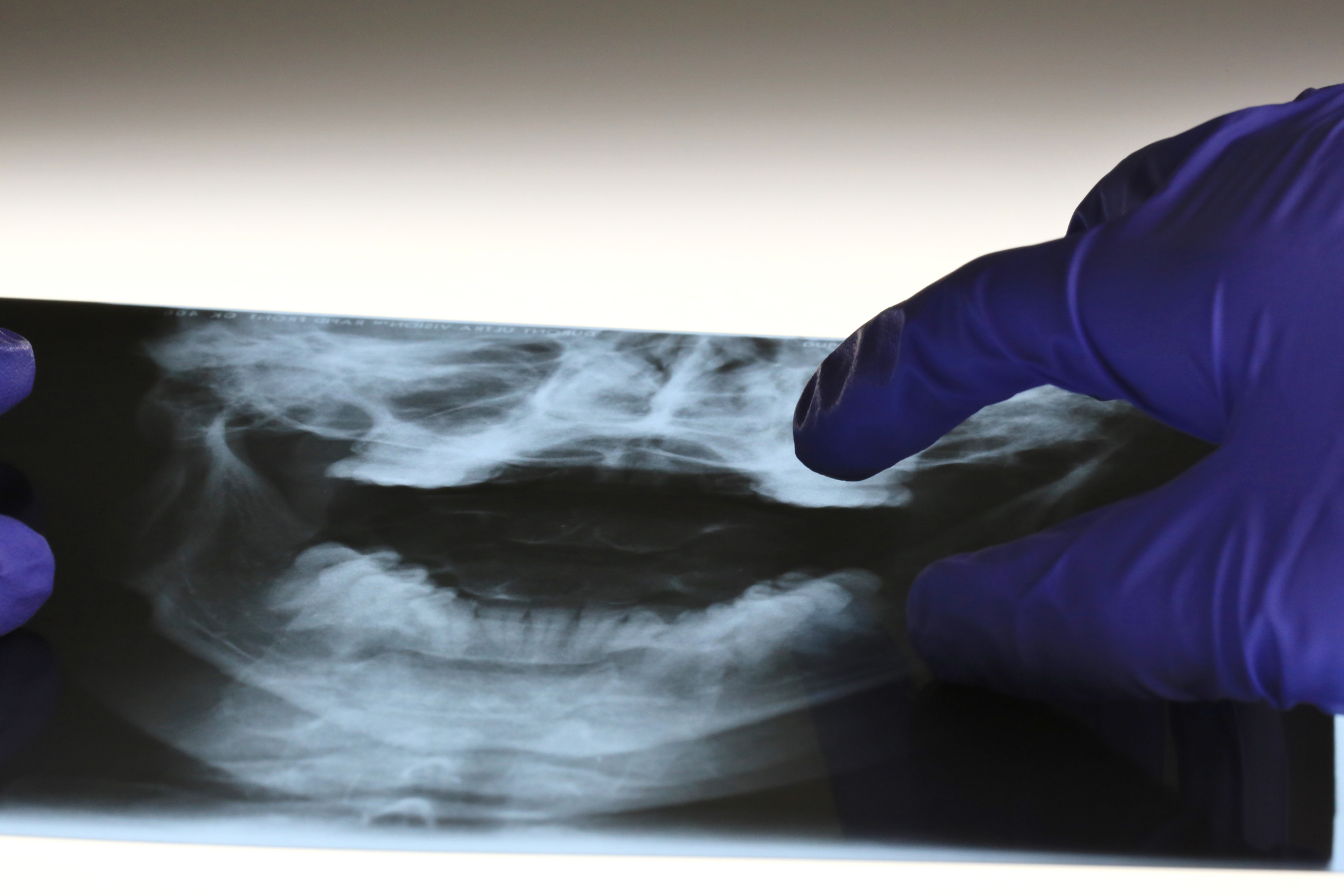 A close-up image of gloved hands examining a dental X-ray