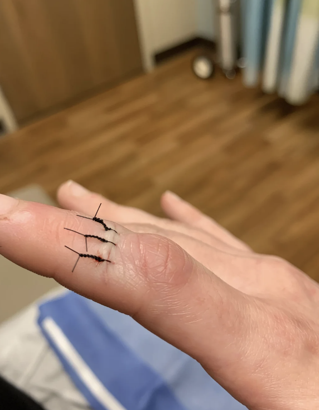 Close-up of a person's finger with stitches. The finger has three visible stitches and is resting on the person's leg. Background shows a room with wood flooring