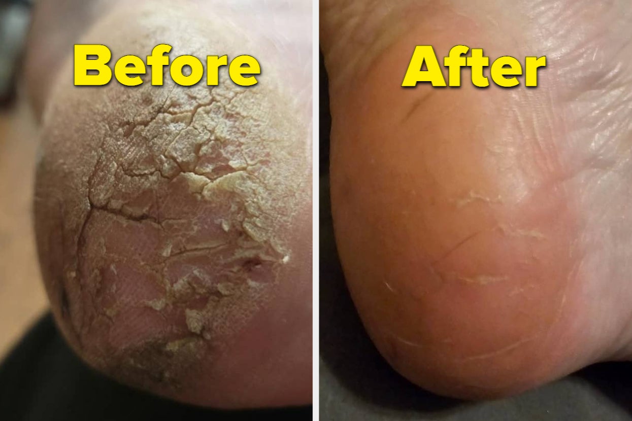 13 Of The Best Callus-Removing Products So You Can Say Hello To Soft, Smooth Feet