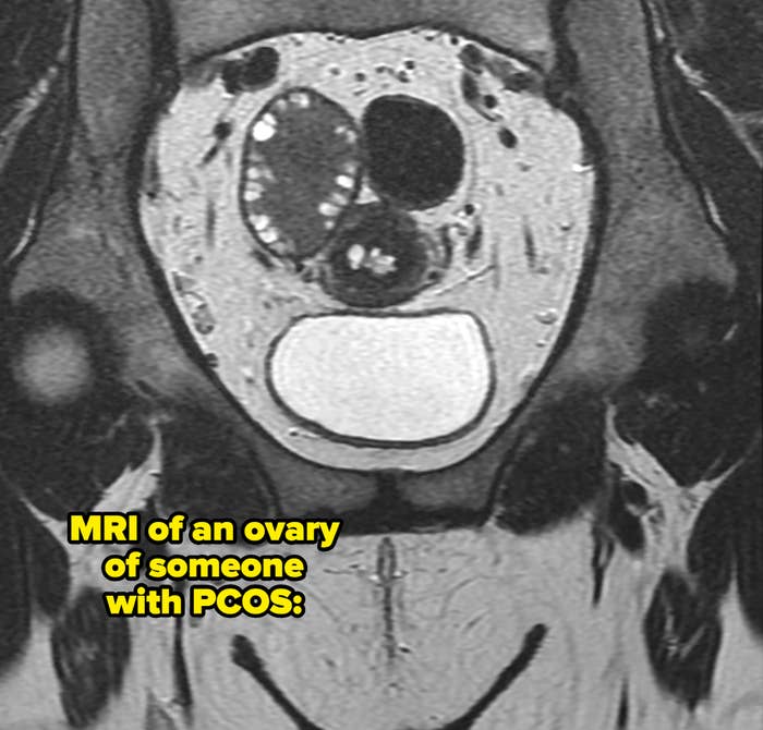An MRI scan showing a cross-sectional view of the abdomen with visible organs and contrasting areas