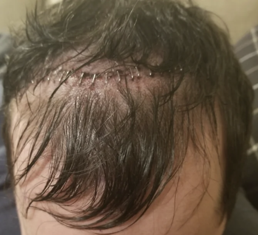 Close-up image of a person's head showing multiple surgical staples in their scalp. The person's hair is wet and brushed aside to expose the staples