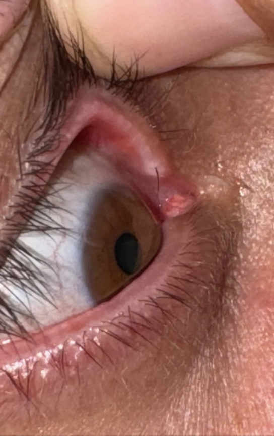 Close-up of an eye with an inflamed and irritated inner corner, displaying a small red bump