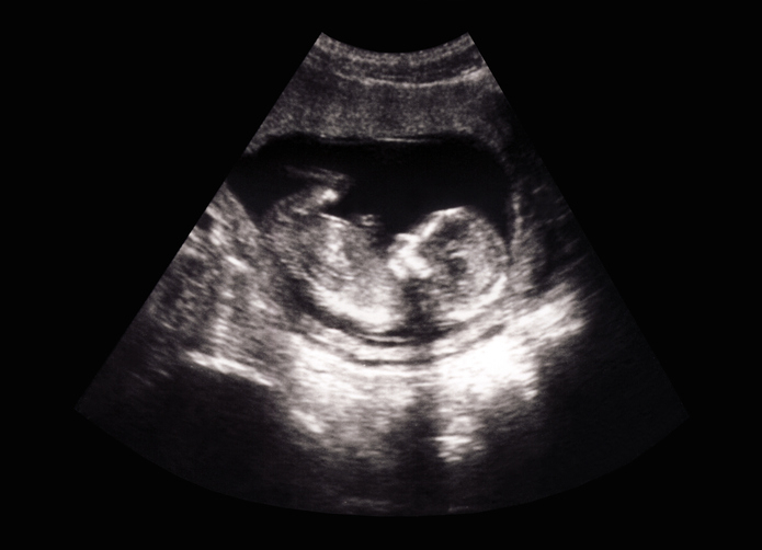 An ultrasound image showing a fetus in the womb