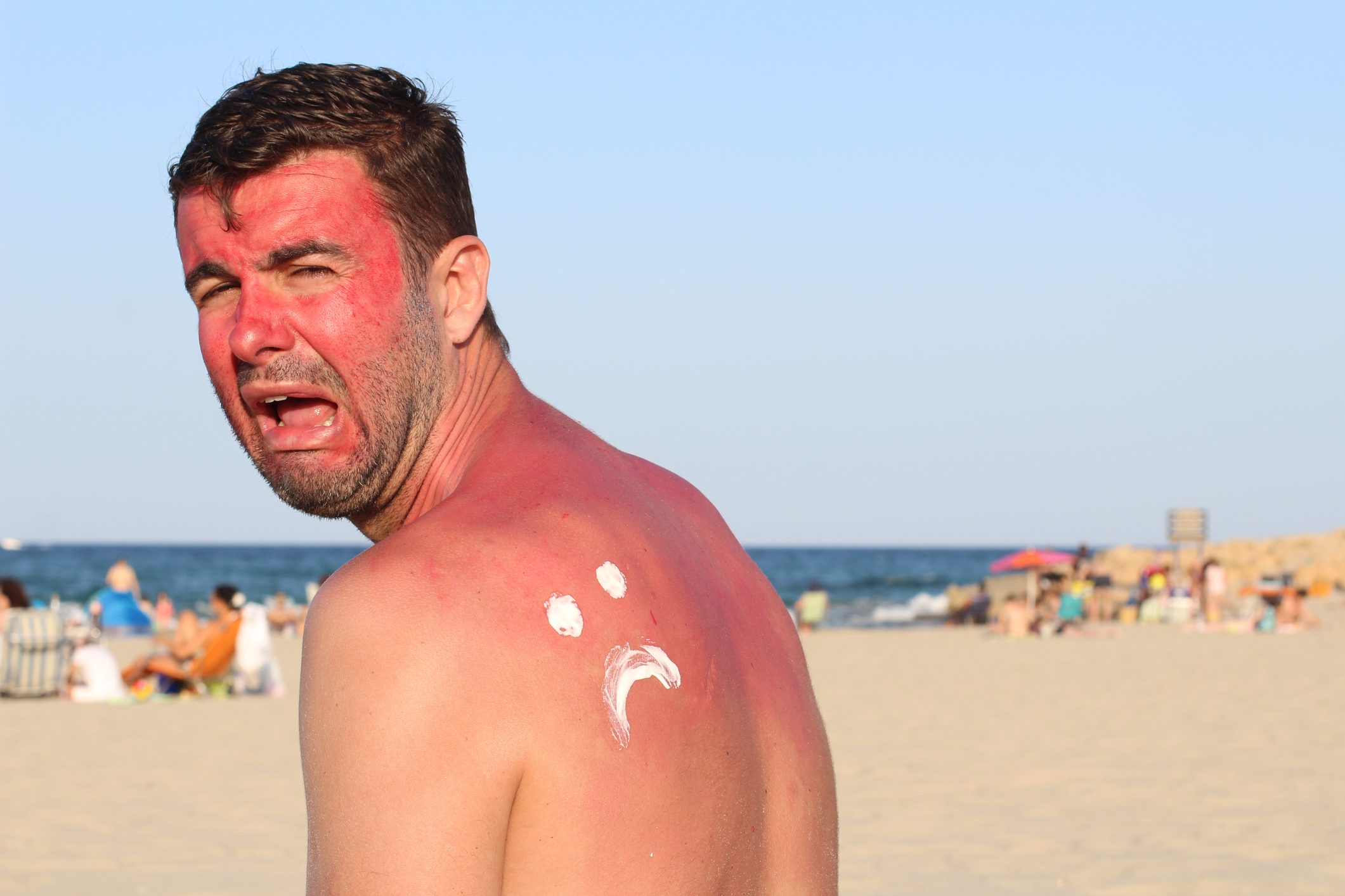 A man with a severe sunburn on his face and back stands on a beach, showing a funny white sad face drawn with sunscreen on his back