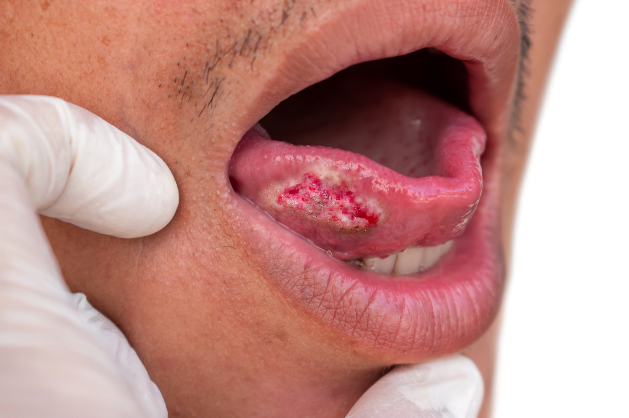 Close-up of a person's mouth with a severe sore on the inside of their lower lip. A gloved hand is pulling the lip down to reveal the sore