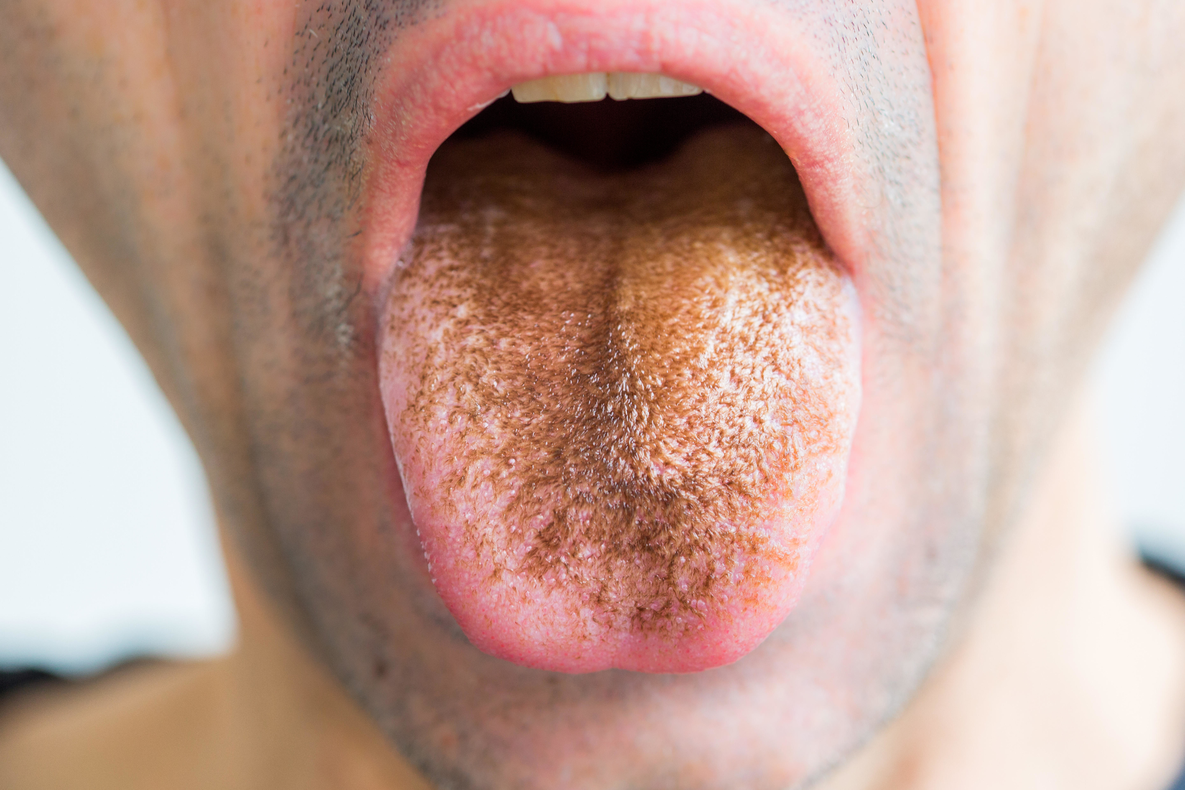 Close-up of a person's open mouth showing their tongue, which has a brown substance coating it. No names provided