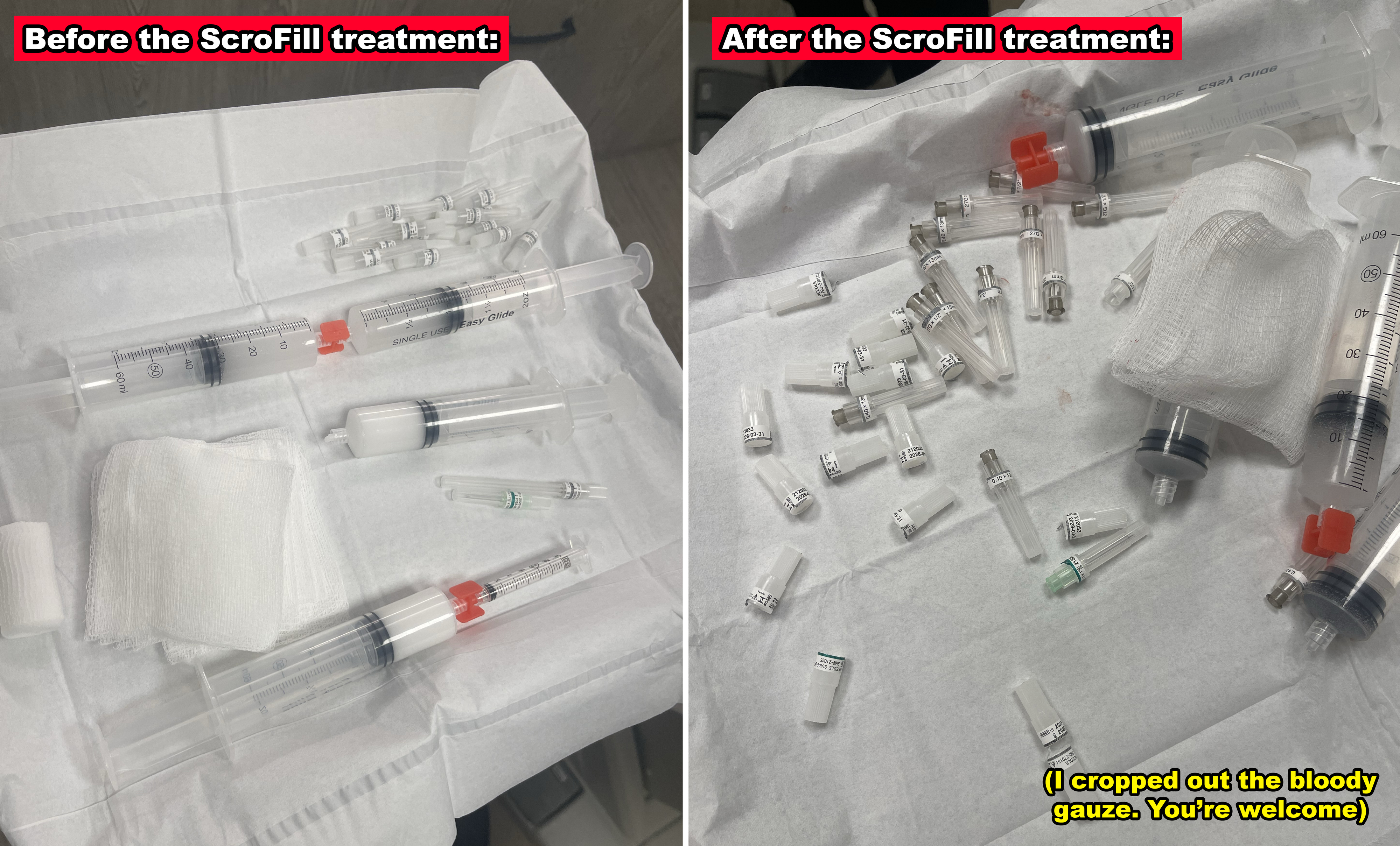 Two images to show all the medical supplies before and after the ScroFill treatment, with the "after" photo featuring everything in disarray