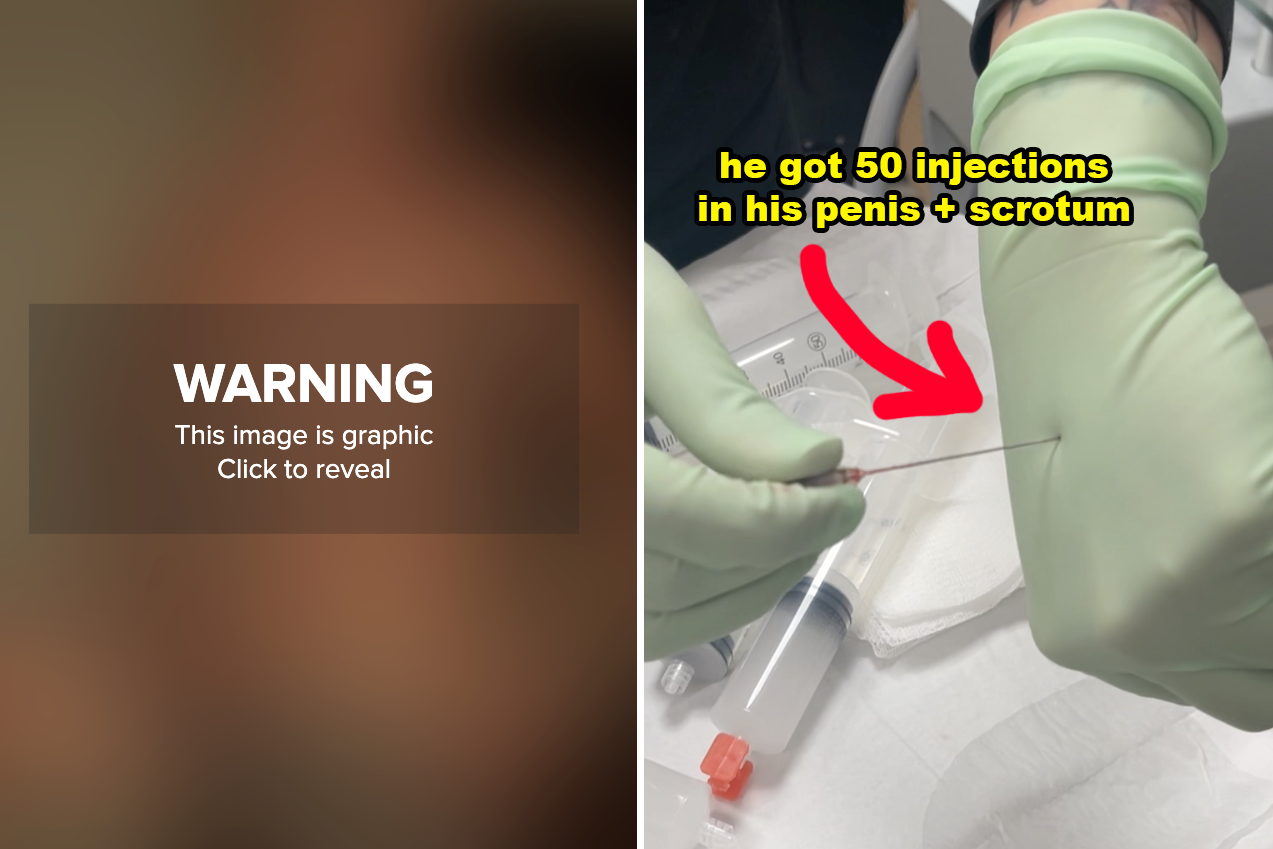 I Watched A Man Get 50 Penis Injections To Make His Dick Thicker — Here's What The Viral Procedure Is Actually Like