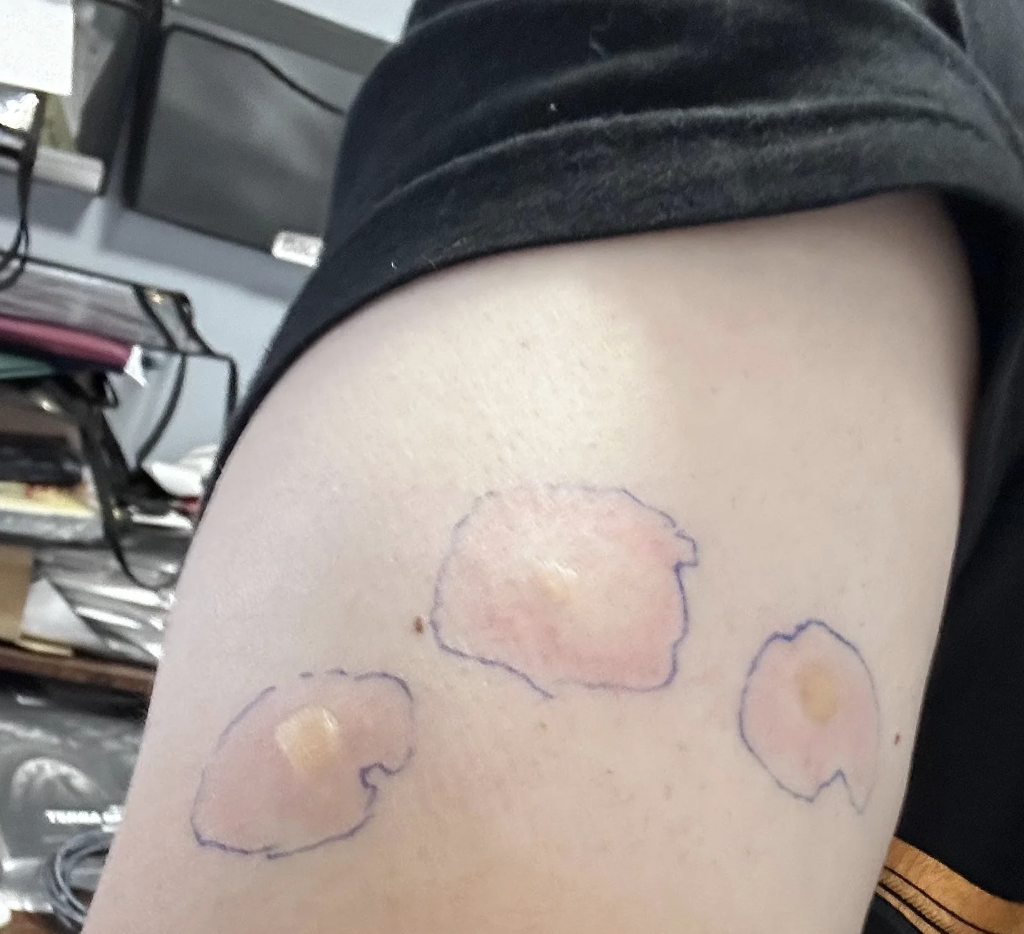 A person's arm with three circular skin patches outlined in blue ink, possibly indicating medical treatment or skin conditions. Other objects in the background