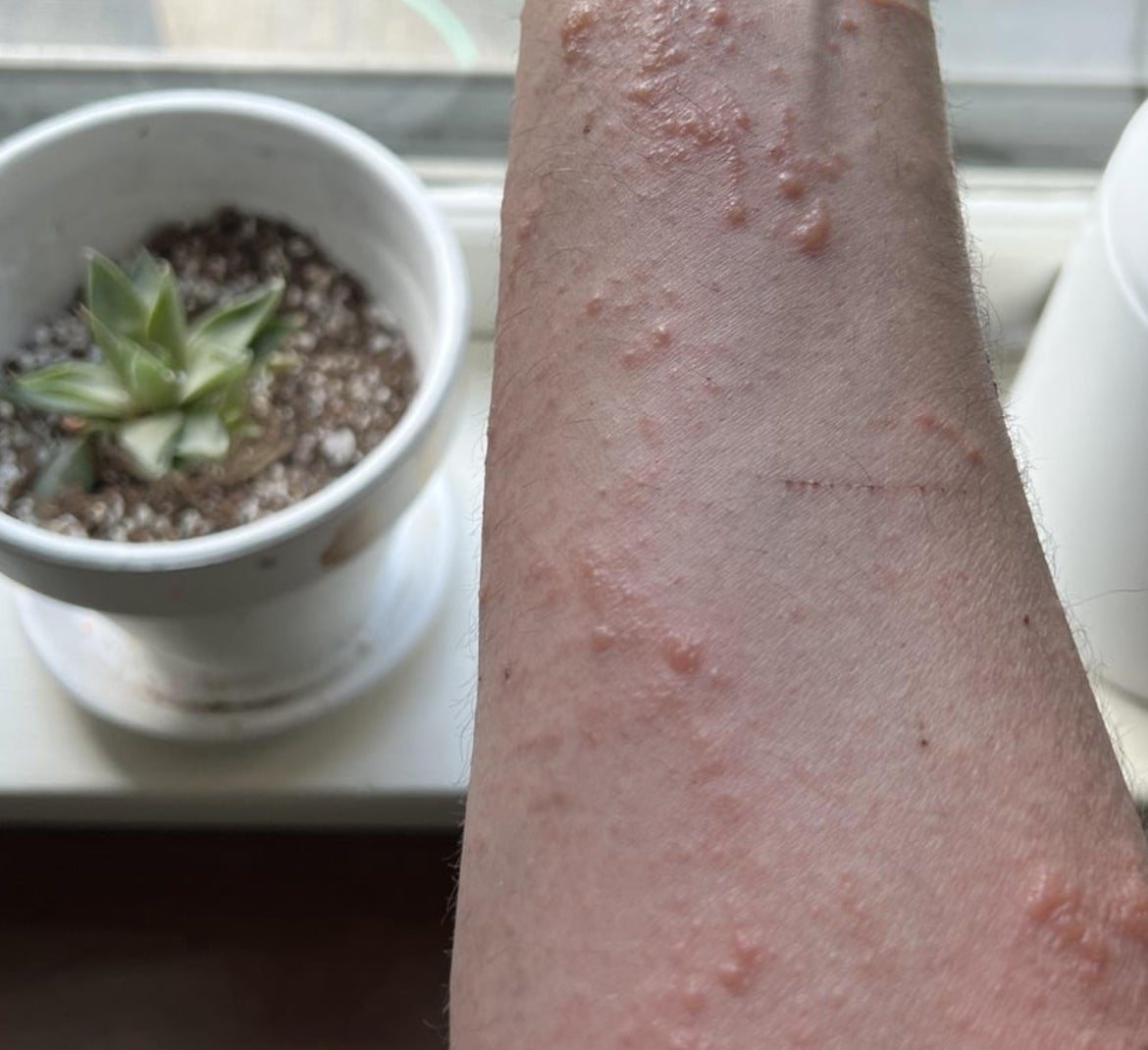 A person's arm with visible redness and bumps, possibly indicating a skin condition