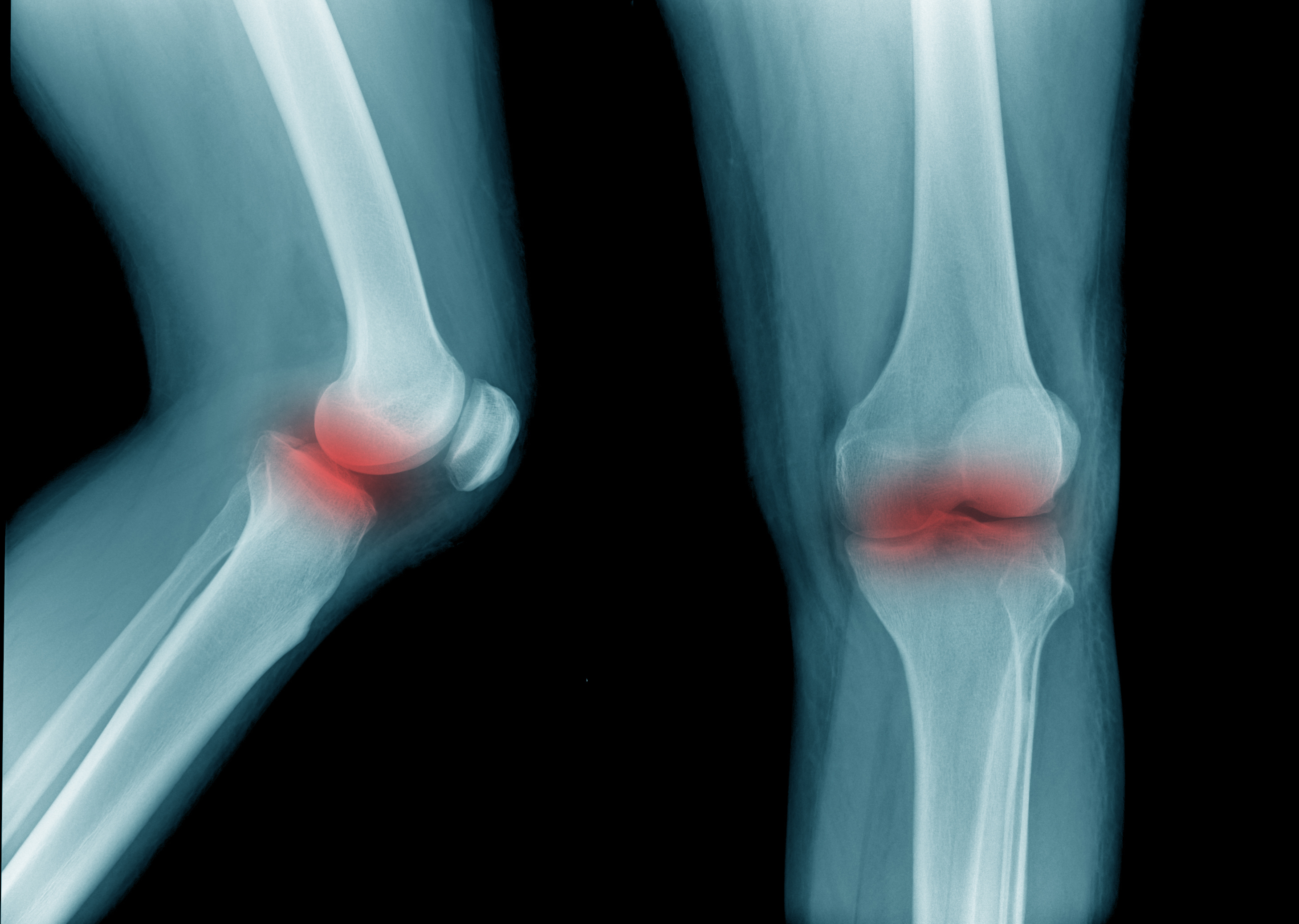 X-ray images showing side and front views of a knee joint with areas highlighted in red, indicating inflammation or injury