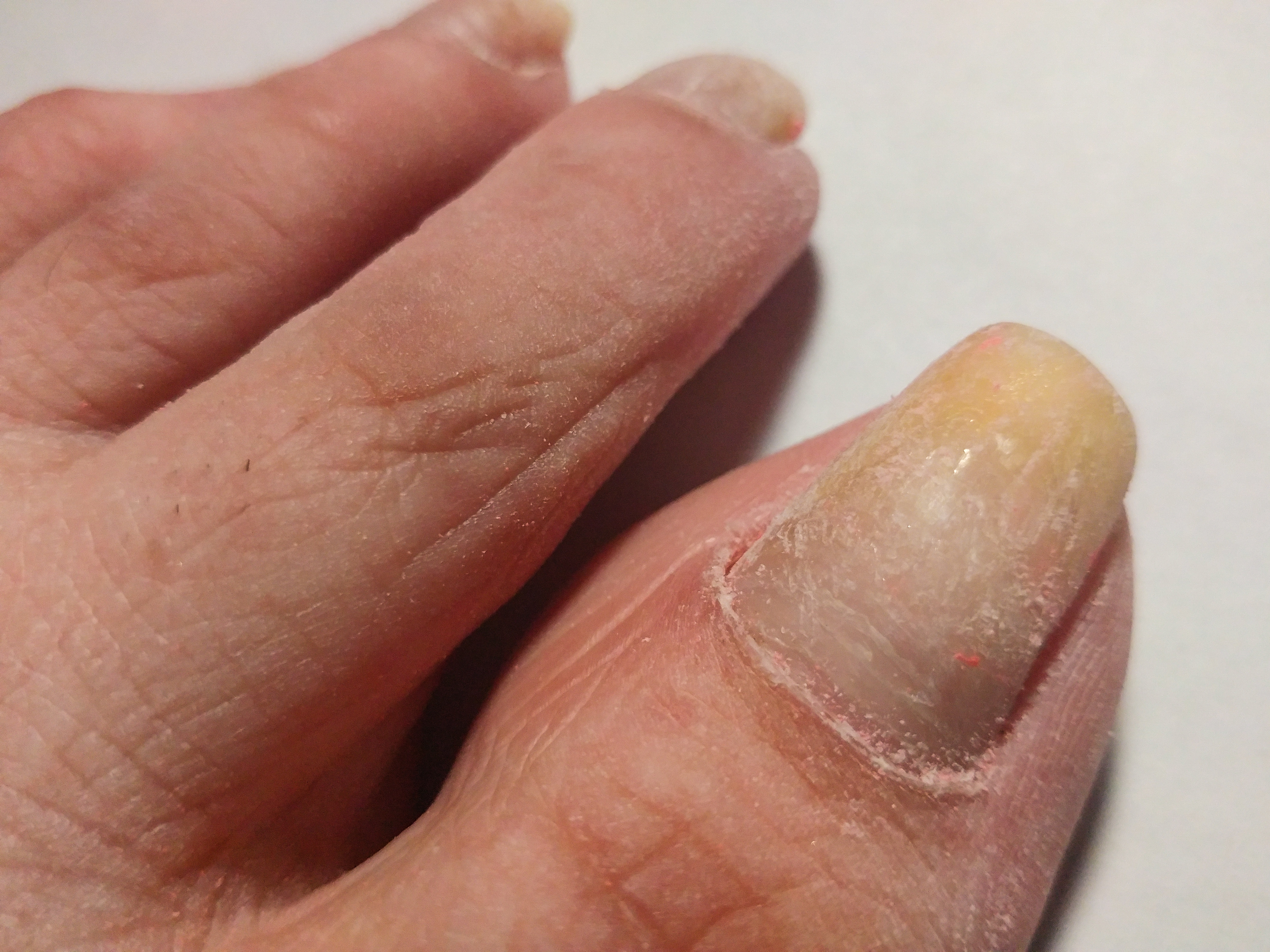 Close-up of a person&#x27;s hand showing a dry, flaky skin condition on the fingers and discolored fingernails