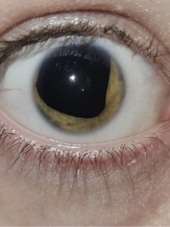 A close-up image of a human eye showing an unusual pigmentation or coloration in the iris and sclera