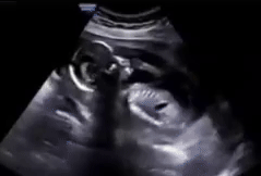 Ultrasound image of a fetus