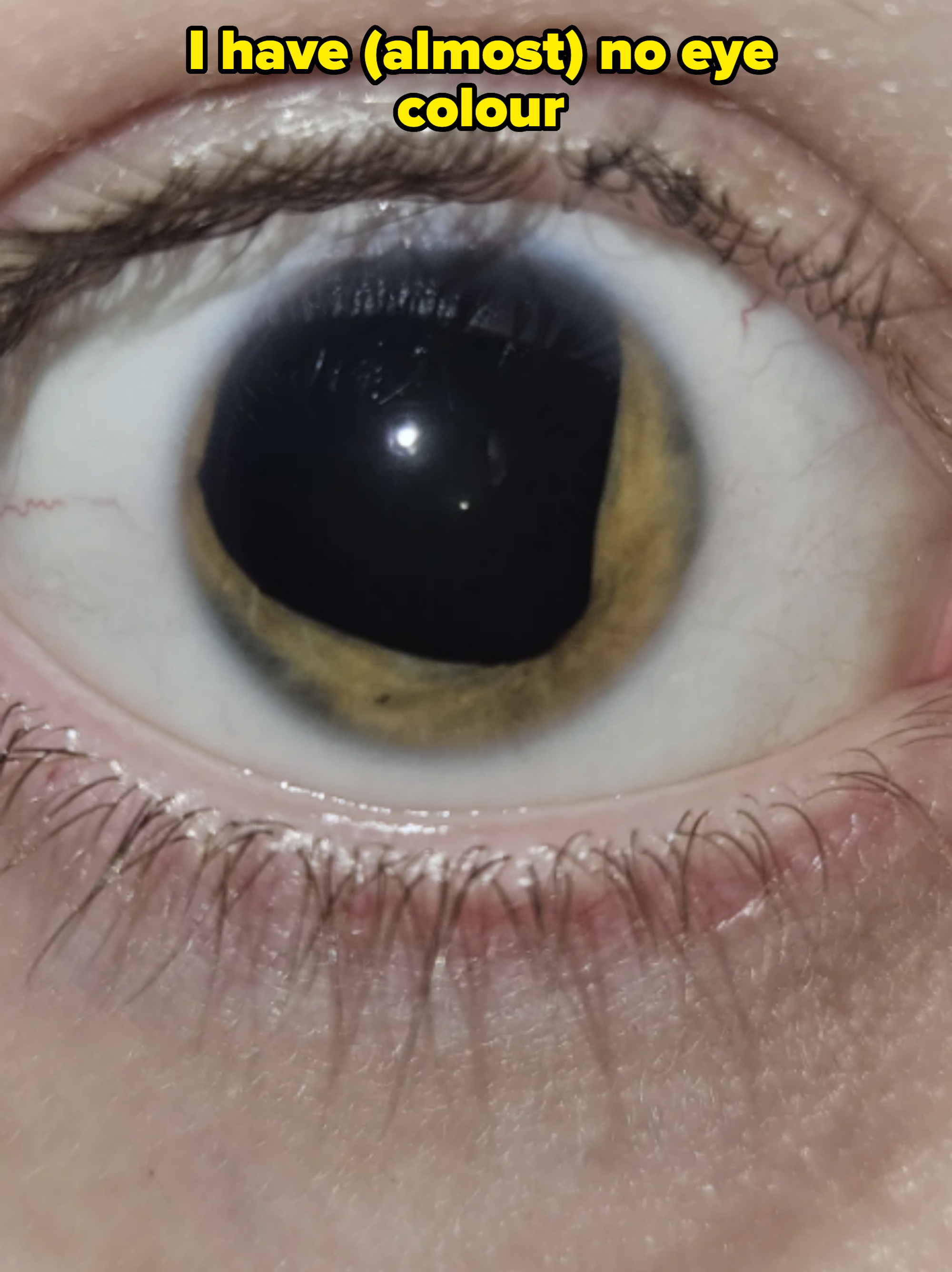 Close-up of a human eye with a black, crescent-shaped area in the iris and a clear, glossy cornea
