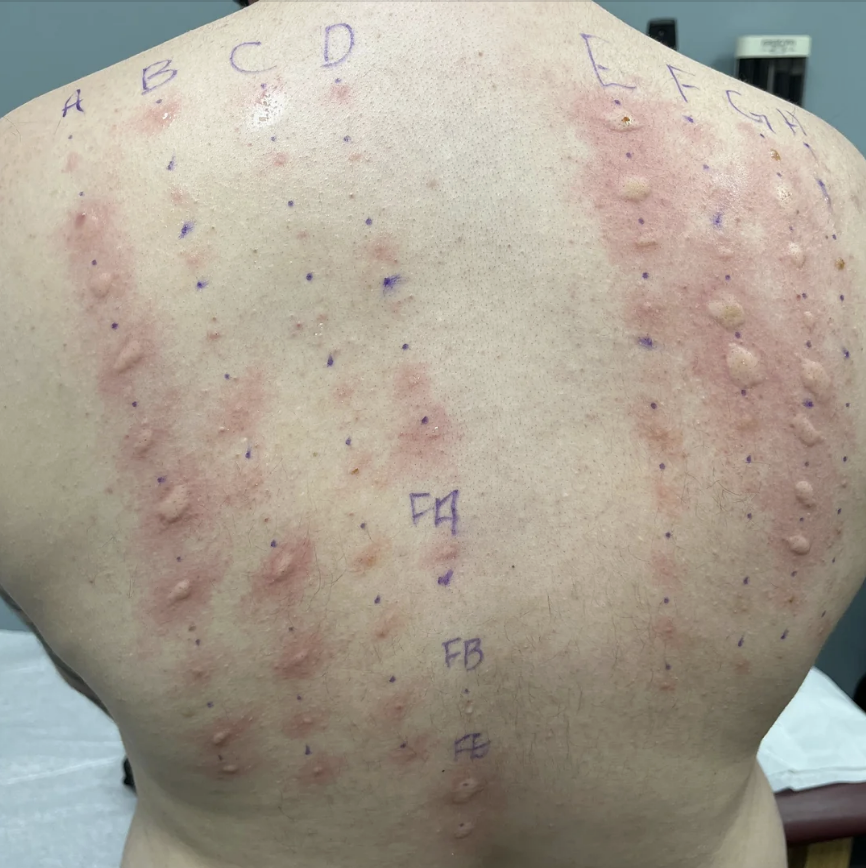 A person's back showing a skin test with numerous raised reactions, marked with letters A-H and F4, FB, FE indicating different allergens