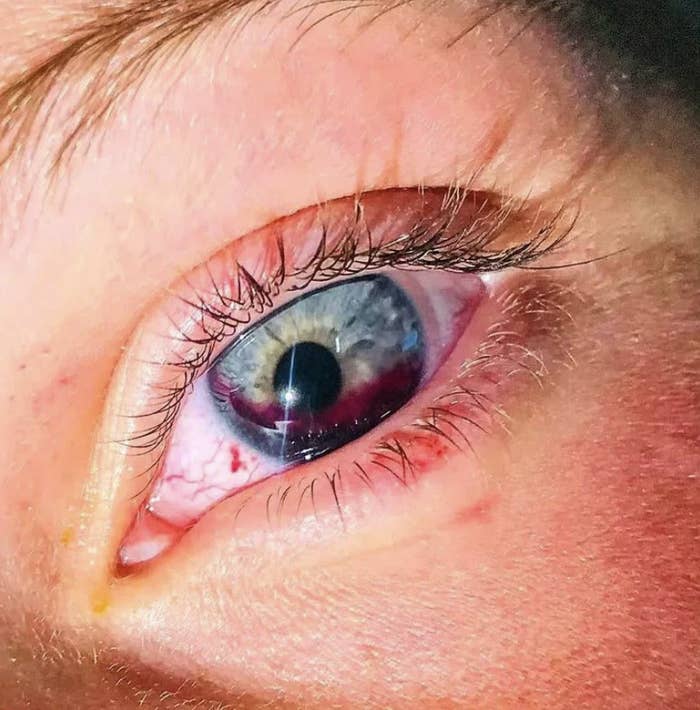 A close-up of a human eye, showing significant redness, irritation, and visible veins around the iris