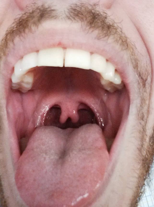Close-up image of a person’s open mouth, showing teeth, tongue, and throat. The person has facial hair