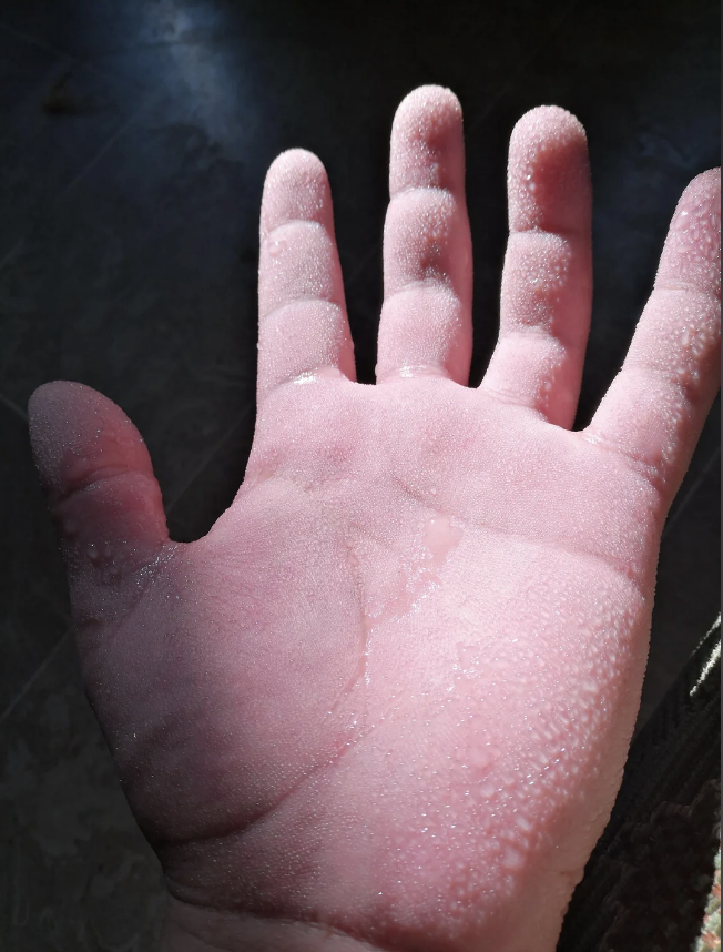 Close-up of a human hand covered in frost, showing frostbite