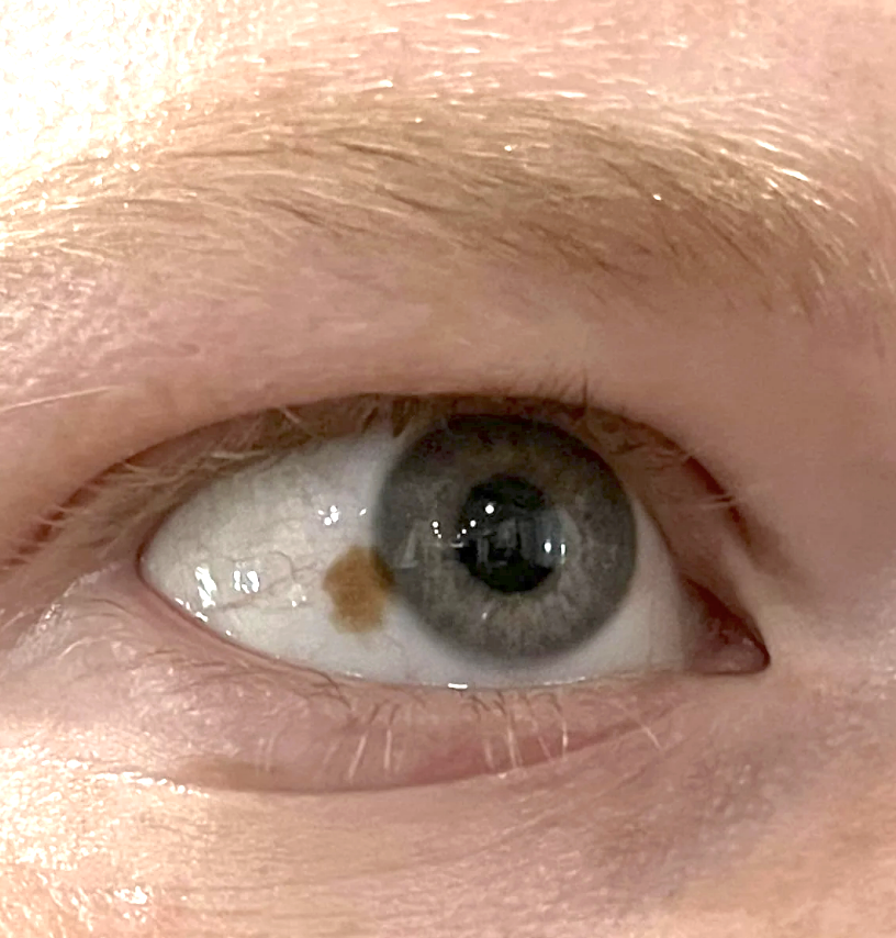Close-up of a person's eye with a small brown spot on the sclera (white part of the eye)