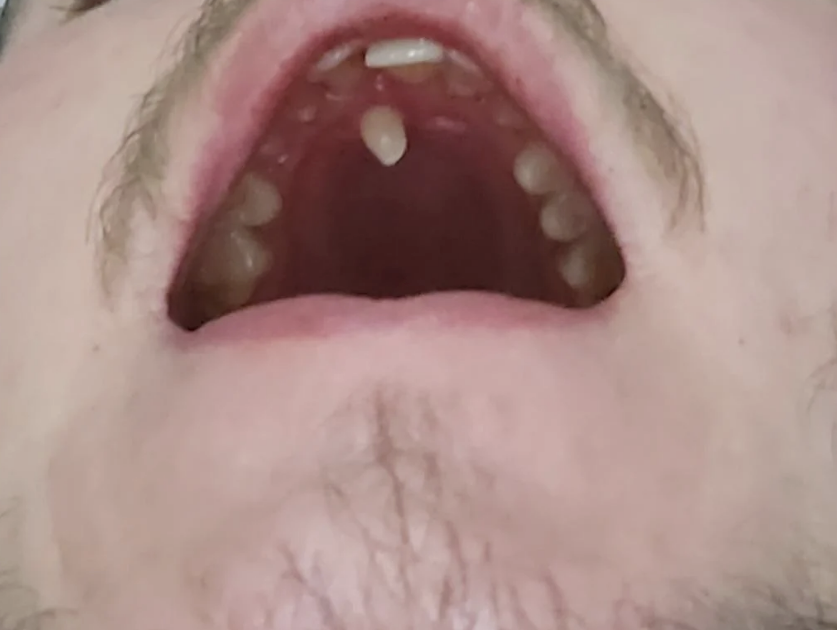A close-up view of an open mouth showing upper teeth and gums. The photo shows dental conditions, including visible growths on the upper gum. No text