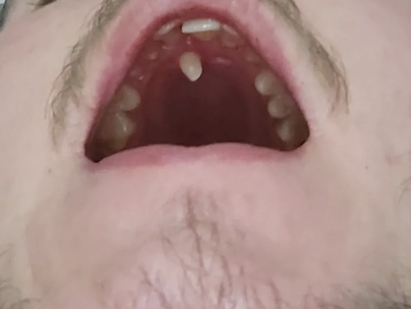 A close-up view of an open mouth showing upper teeth and gums. The photo shows dental conditions, including visible growths on the upper gum. No text