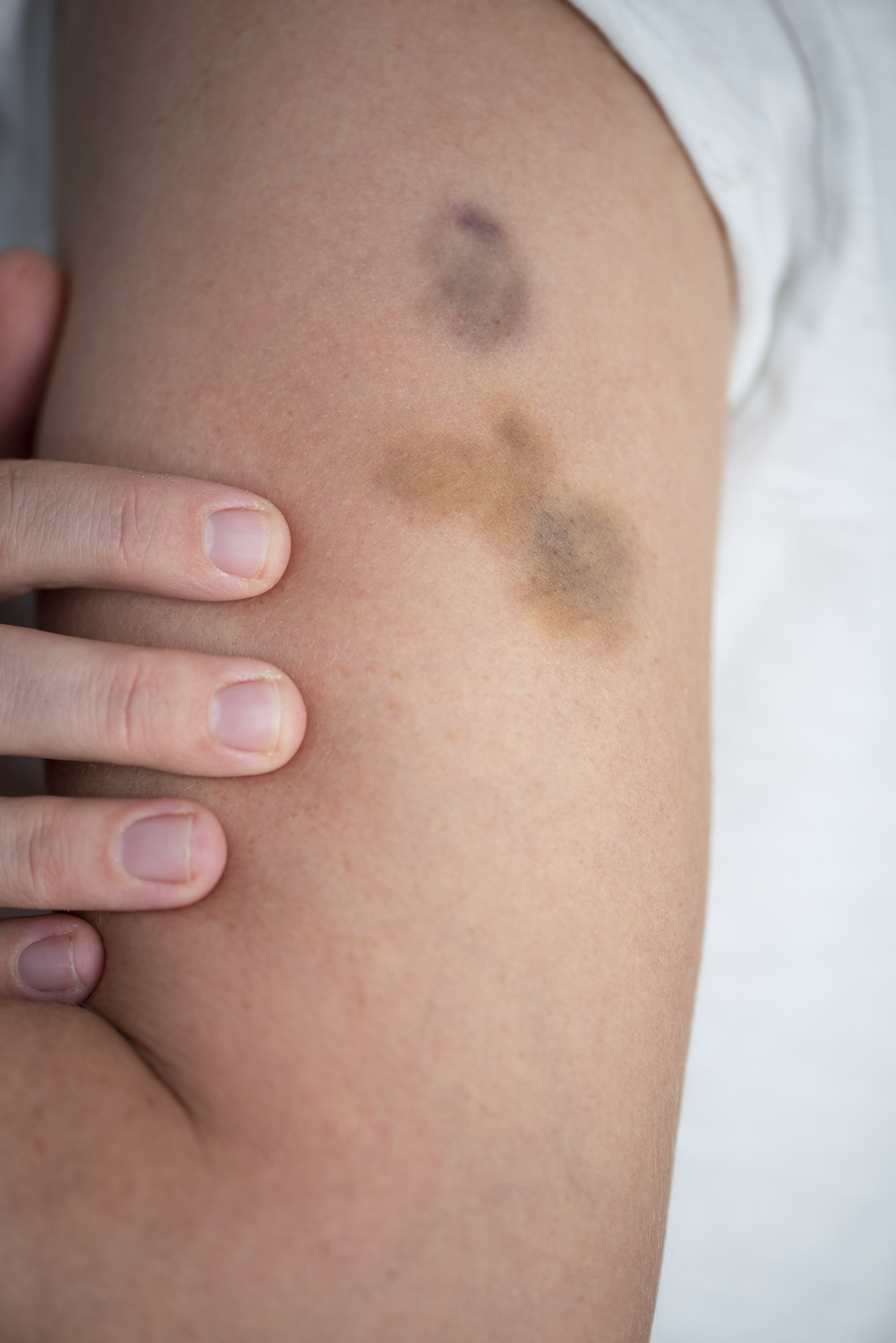 A close-up of a person's arm with bruises, showing discoloration. A hand with trimmed nails gently touches the arm