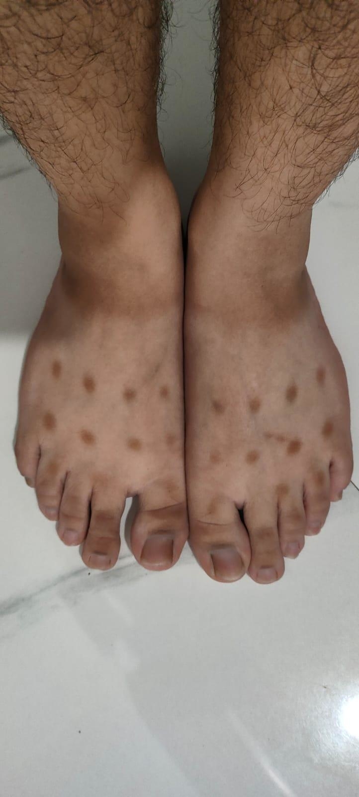 A pair of feet showing circular tan lines on the tops, possibly from wearing footwear with circular holes regularly