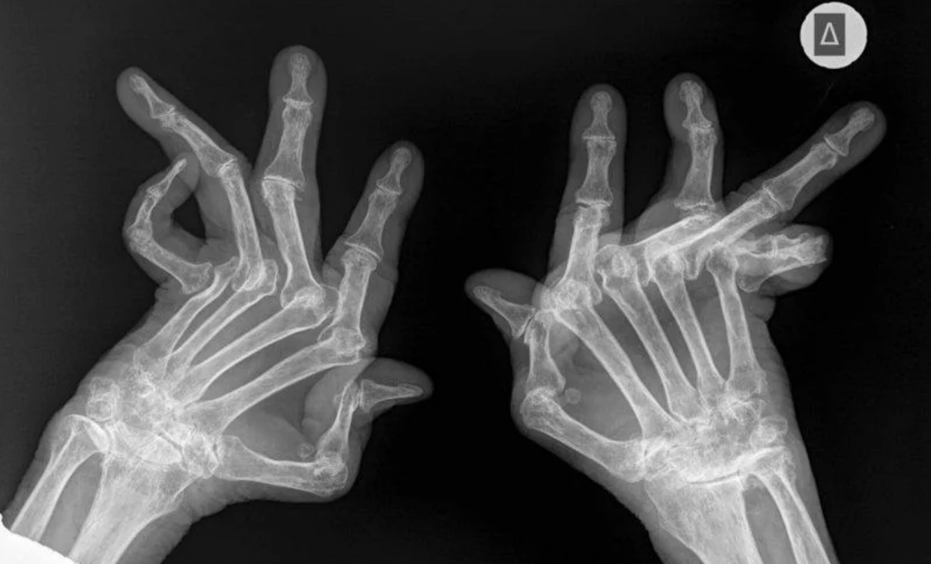 X-ray image showing two hands with clearly visible bones; fingers appear twisted or deformed