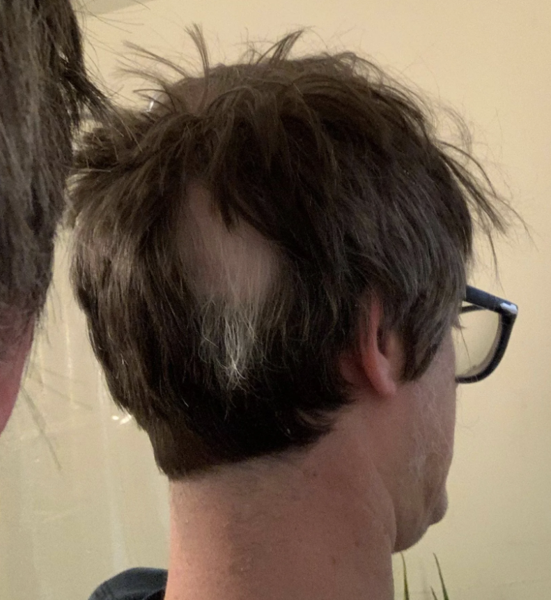 View of a man's head from the back showing thinning hair and a prominent bald spot