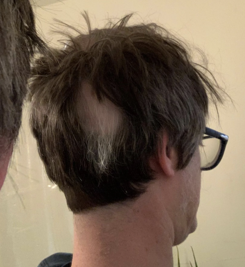 View of a man's head from the back showing thinning hair and a prominent bald spot