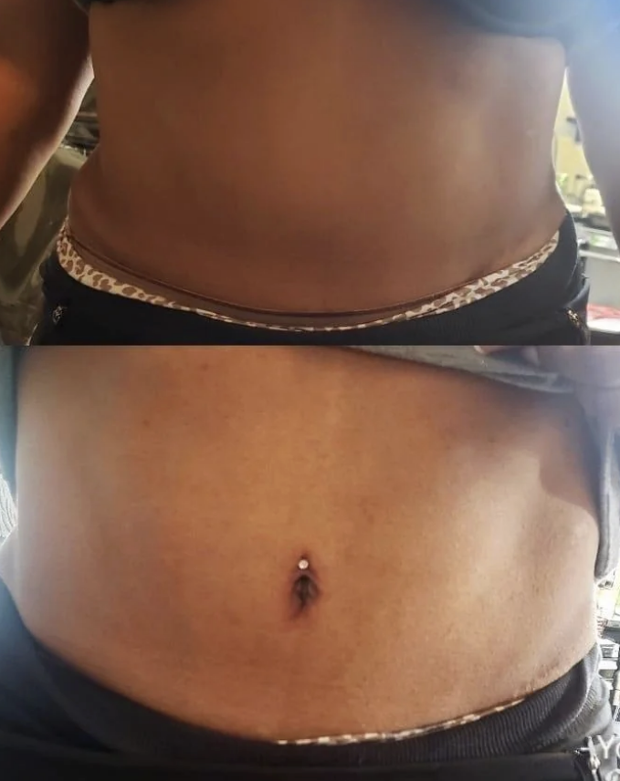Two close-up shots of a person's midriff showing weight loss progress from before (top) to after (bottom)